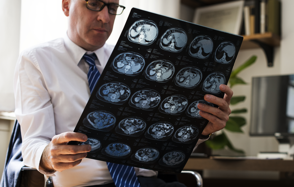 Glioblastoma | Recurrence, Symptoms And Treatment Options