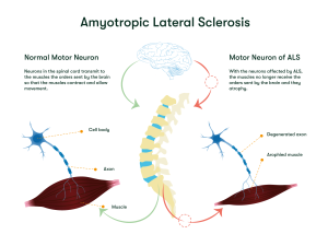 Illustration comparing a normal motor neuron and a motor neuron affected by ALS. The normal neuron can transmit signals to the muscles, while the ALS-affected neuron shows degeneration, preventing muscle activation and leading to muscle atrophy